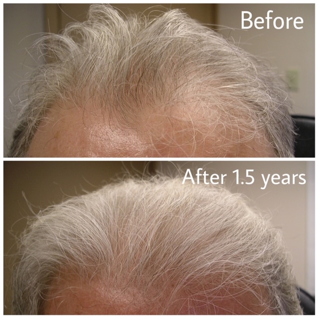 A man with gray hair and before and after pictures of his hair.