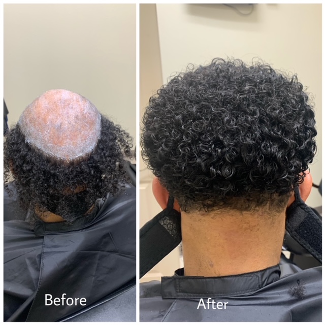 A before and after picture of a man 's hair transplant.